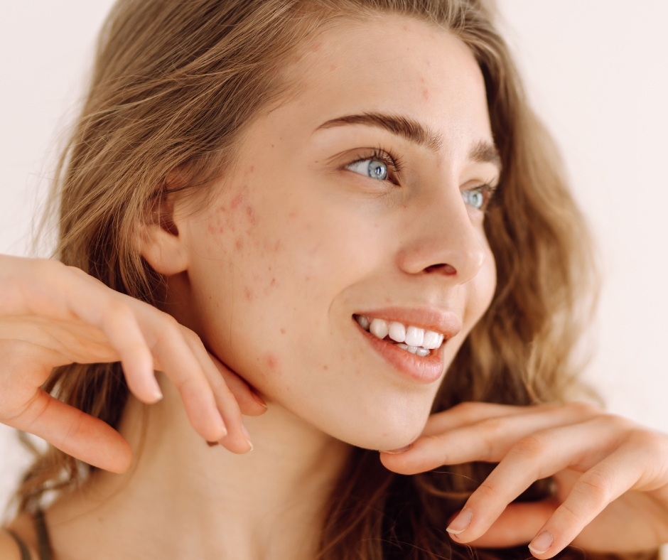 Peau à imperfections, causes et soins